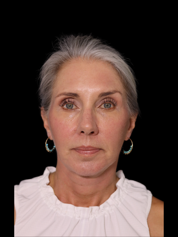 Deep Plane Facelift Gallery Before & After