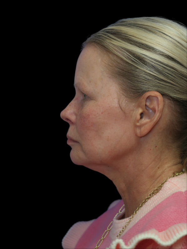 Deep Plane Facelift Gallery Before & After