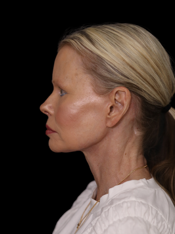 Deep Plane Facelift Gallery Before & After