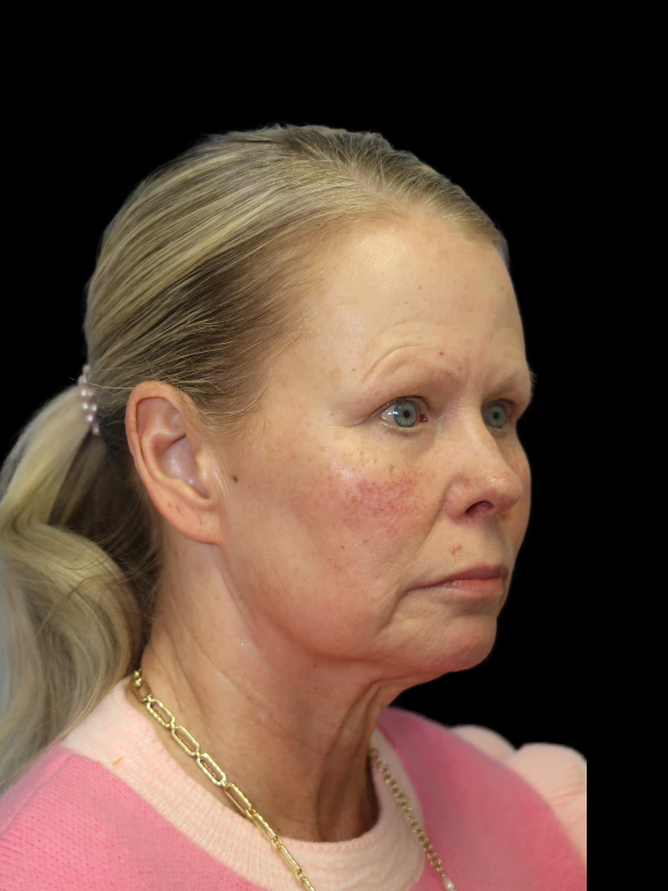 Deep Plane Facelift Gallery Before & After