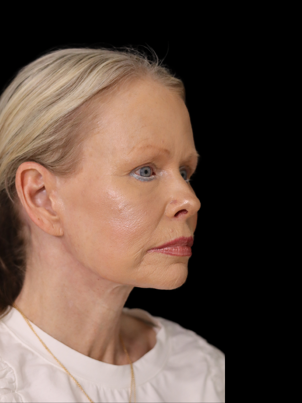 Deep Plane Facelift Gallery Before & After