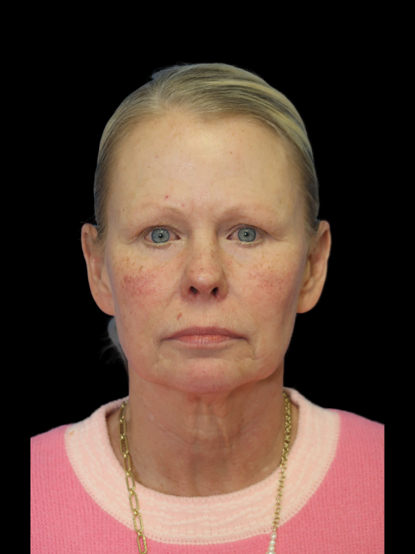 Deep Plane Facelift Gallery Before & After