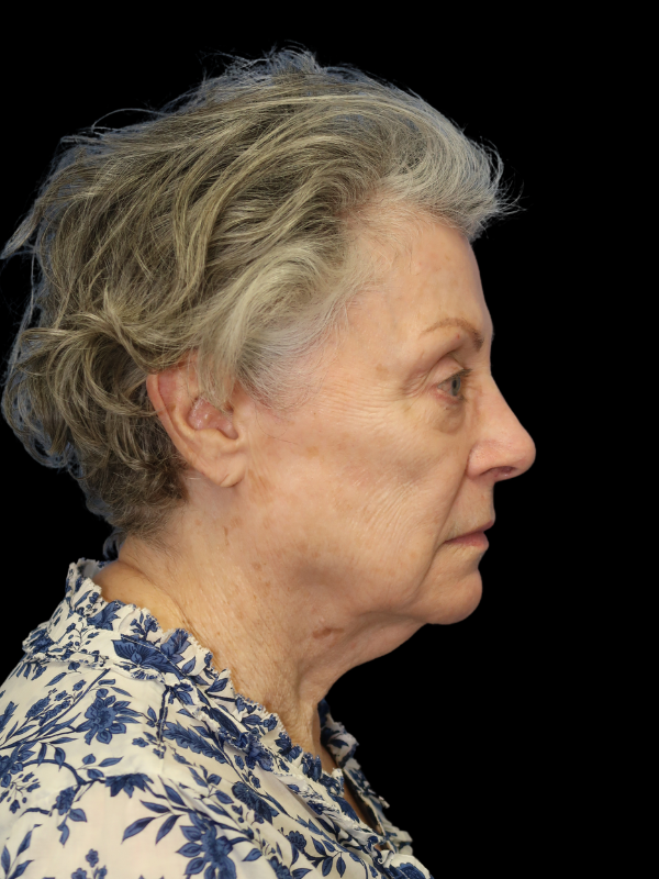 Deep Plane Facelift Gallery Before & After