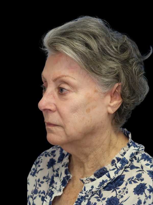 Deep Plane Facelift Gallery Before & After