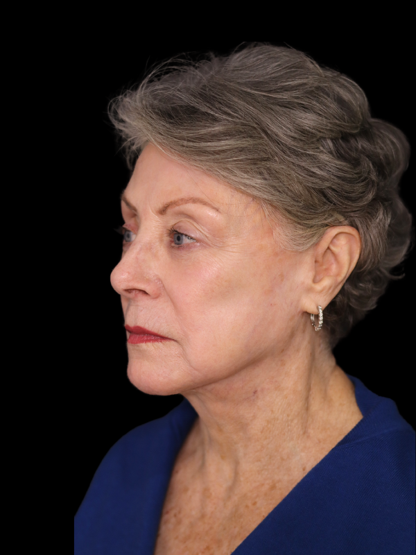 Deep Plane Facelift Gallery Before & After