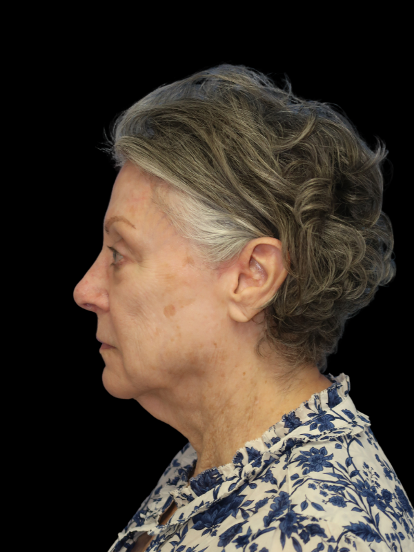 Deep Plane Facelift Gallery Before & After