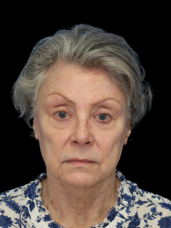 Deep Plane Facelift Gallery Before & After