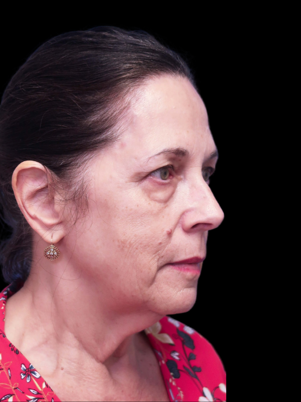 Deep Plane Facelift Gallery Before & After