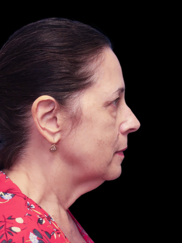 Deep Plane Facelift Gallery Before & After