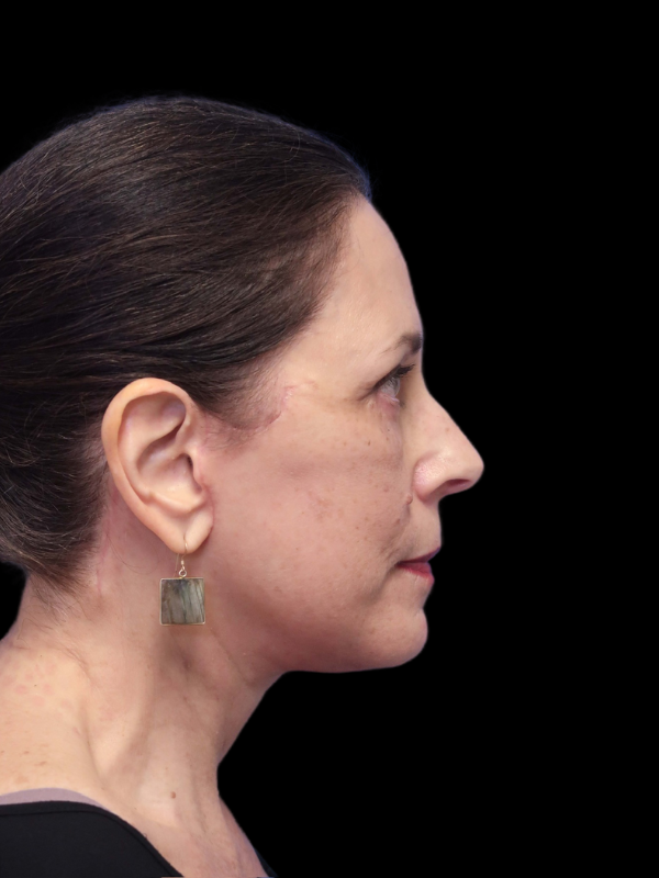 Deep Plane Facelift Gallery Before & After