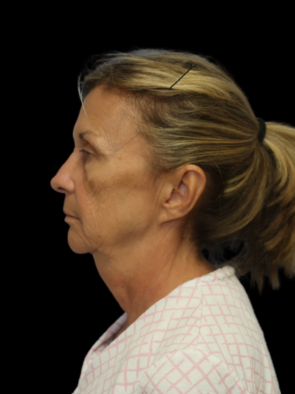 Deep Plane Facelift Gallery Before & After