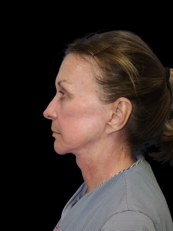 Deep Plane Facelift Gallery Before & After