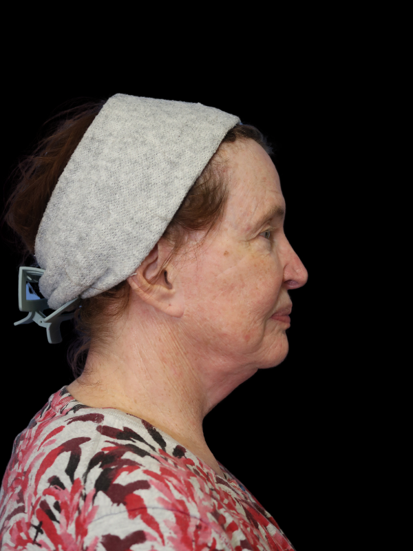 Deep Plane Facelift Gallery Before & After