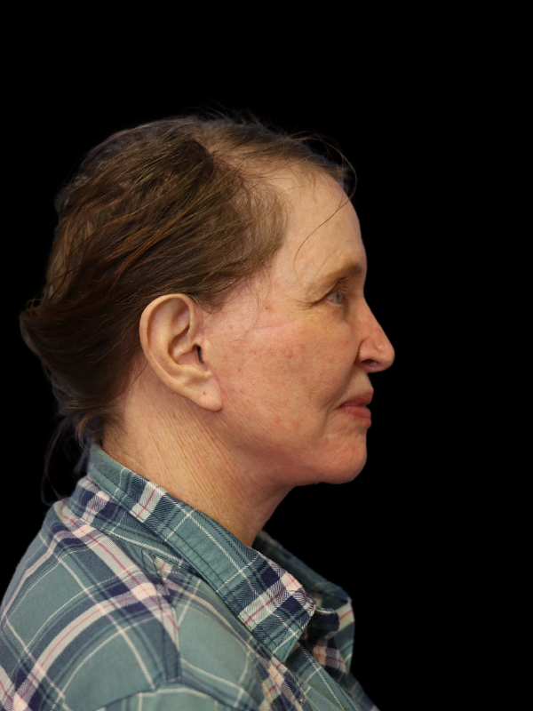 Deep Plane Facelift Gallery Before & After