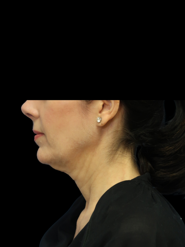 Deep Plane Facelift Gallery Before & After