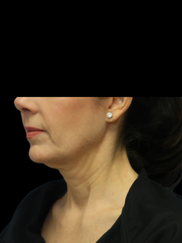 Deep Plane Facelift Gallery Before & After