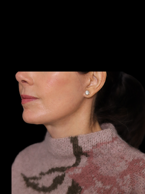 Deep Plane Facelift Gallery Before & After