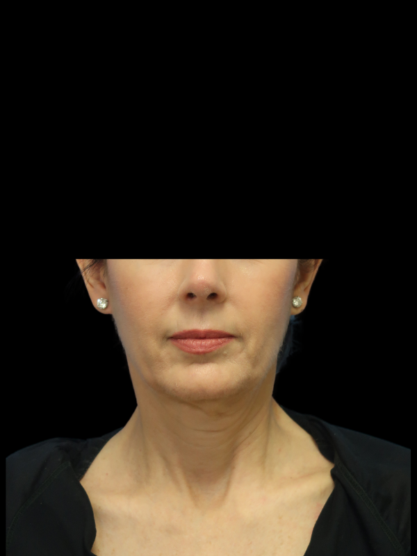 Deep Plane Facelift Gallery Before & After