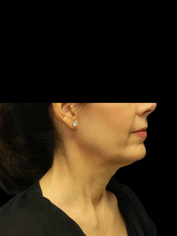 Deep Plane Facelift Gallery Before & After