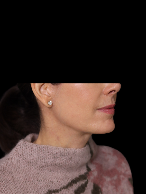 Deep Plane Facelift Gallery Before & After