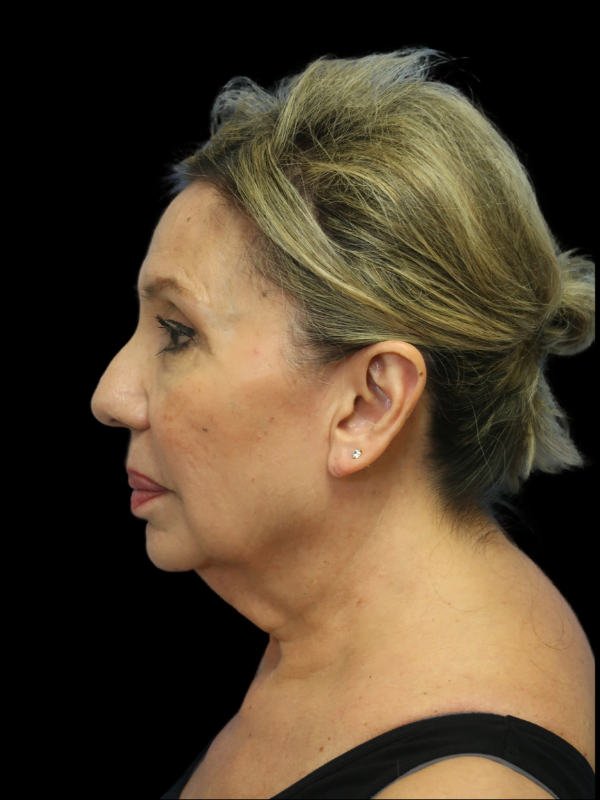 Deep Plane Facelift Gallery Before & After