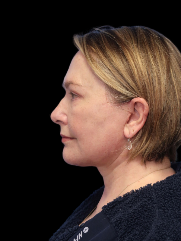 Deep Plane Facelift Gallery Before & After