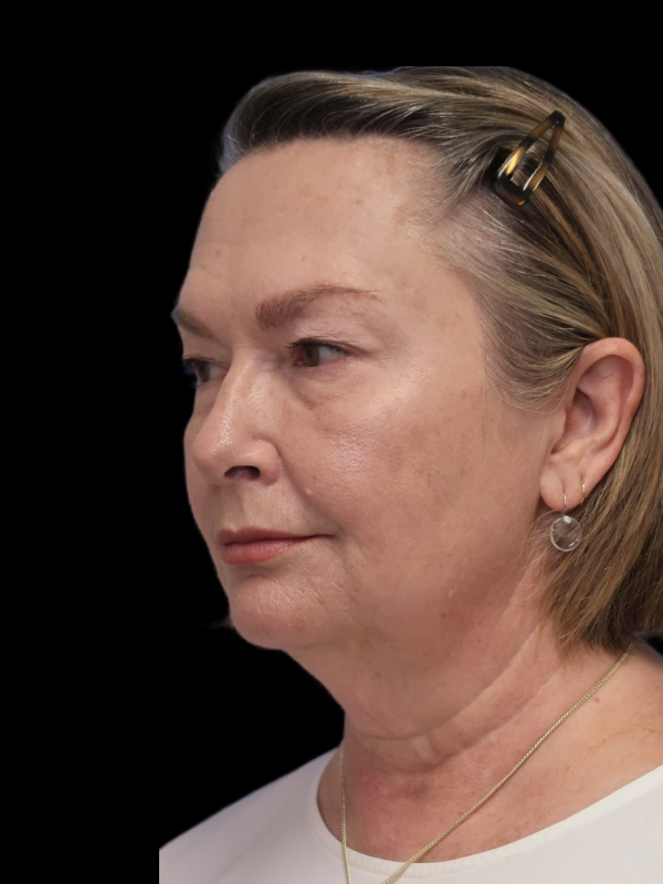 Deep Plane Facelift Gallery Before & After