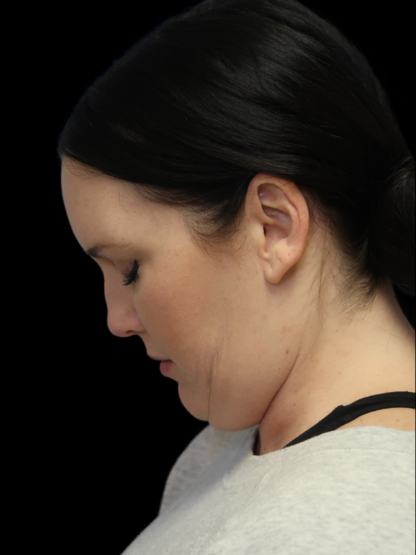 Deep Plane Facelift Gallery Before & After