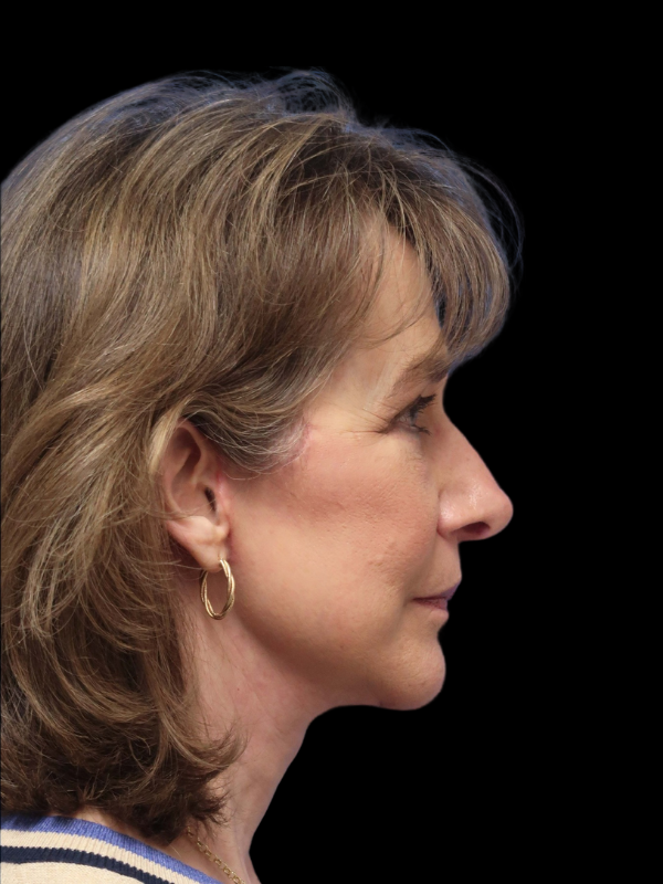 Deep Plane Facelift Gallery Before & After