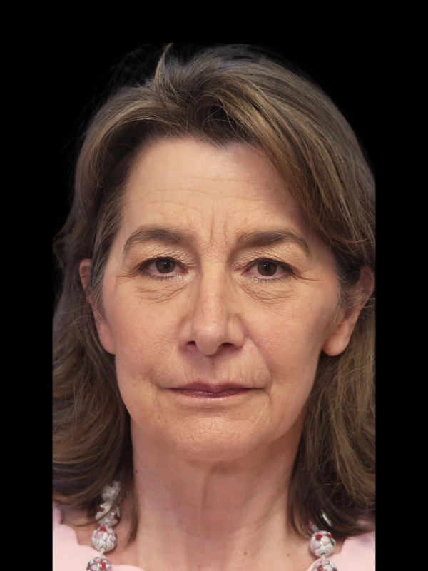 Deep Plane Facelift Gallery Before & After