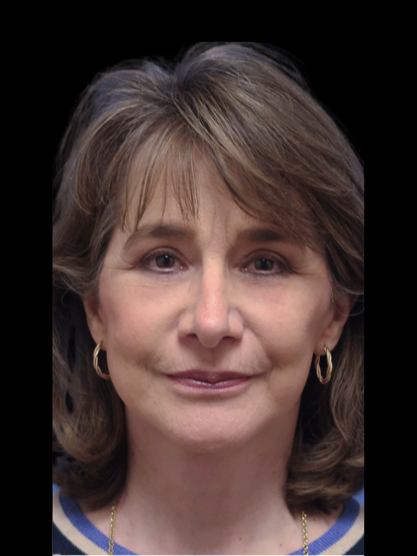 Deep Plane Facelift Gallery Before & After