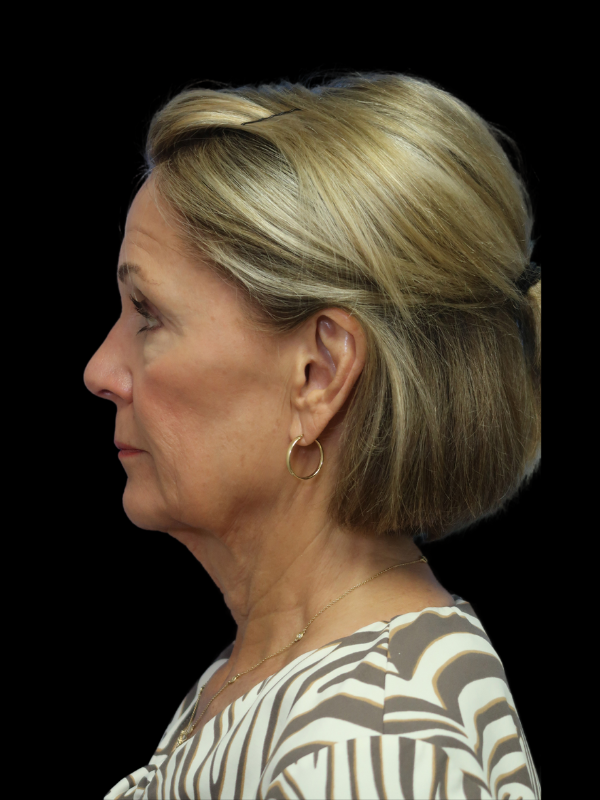 Deep Plane Facelift Gallery Before & After