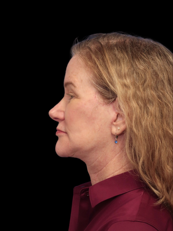 Deep Plane Facelift Gallery Before & After