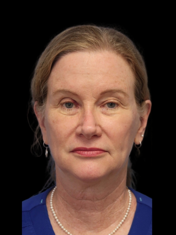 Deep Plane Facelift Gallery Before & After