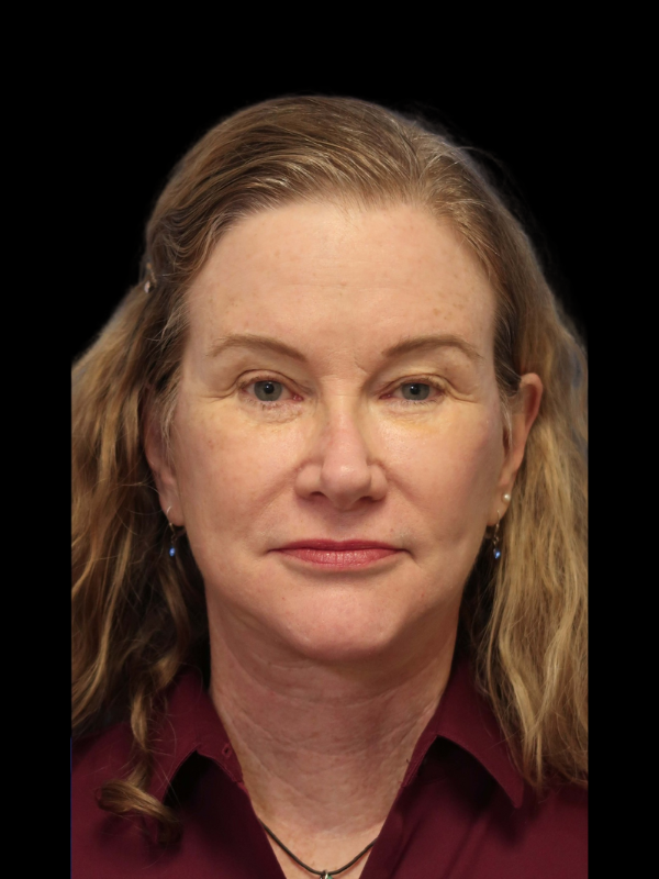 Deep Plane Facelift Gallery Before & After