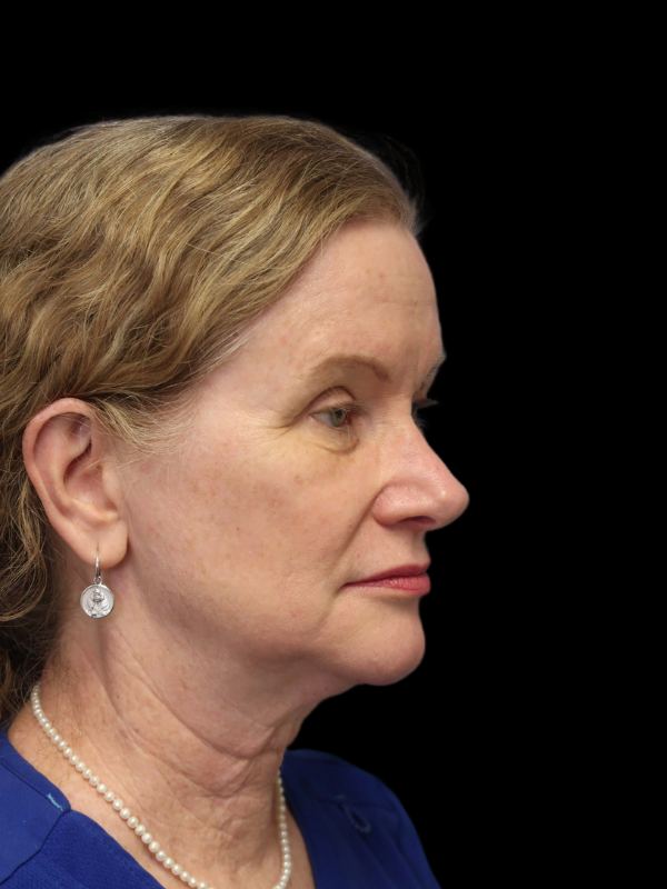 Deep Plane Facelift Gallery Before & After