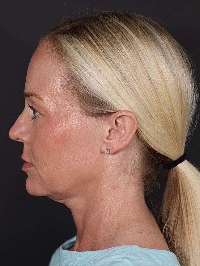 Deep Plane Facelift Gallery Before & After