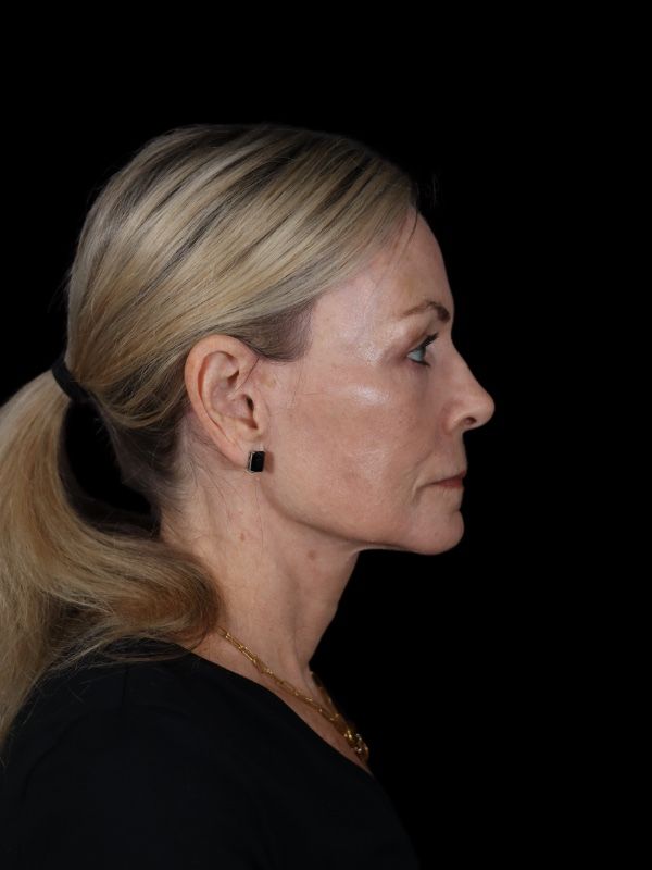 Deep Plane Facelift Gallery Before & After