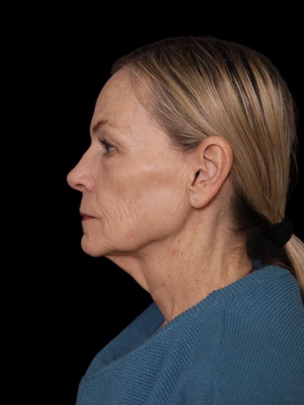 Deep Plane Facelift Gallery Before & After