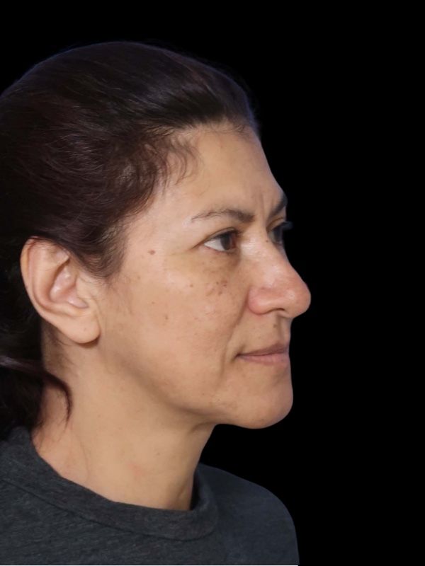 Deep Plane Facelift Gallery Before & After