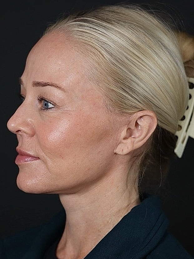 Deep Plane Facelift Gallery Before & After