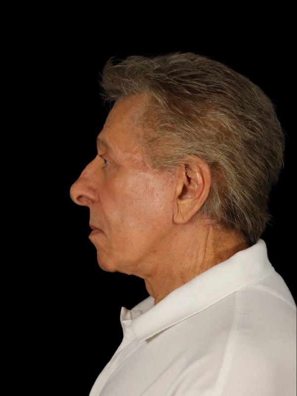 Deep Plane Facelift Gallery Before & After