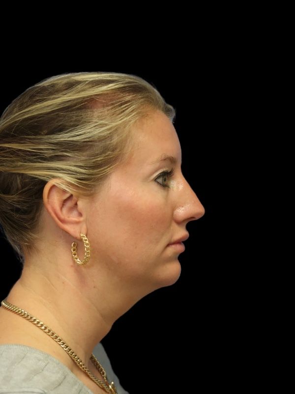 Deep Plane Facelift Gallery Before & After