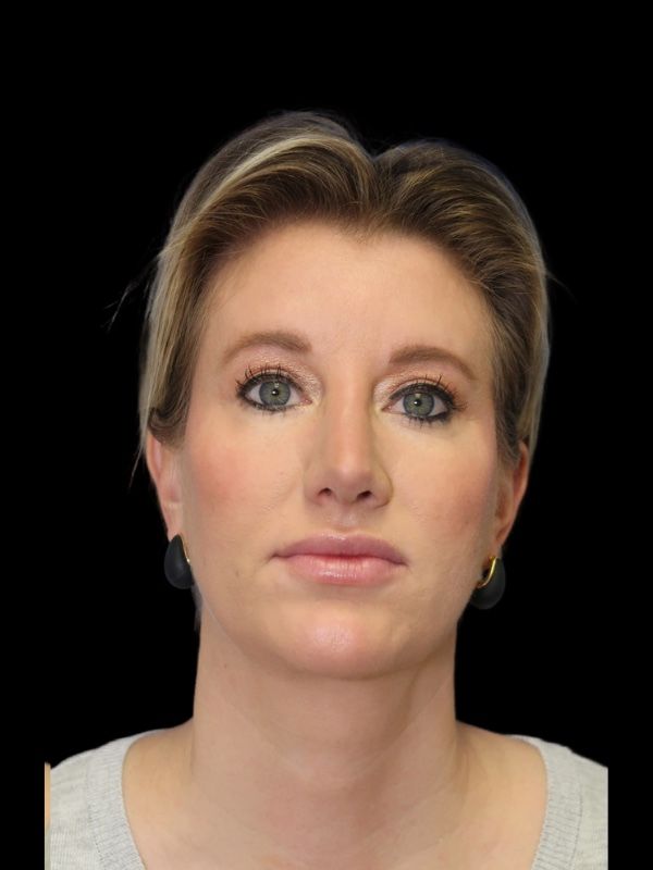 Deep Plane Facelift Gallery Before & After