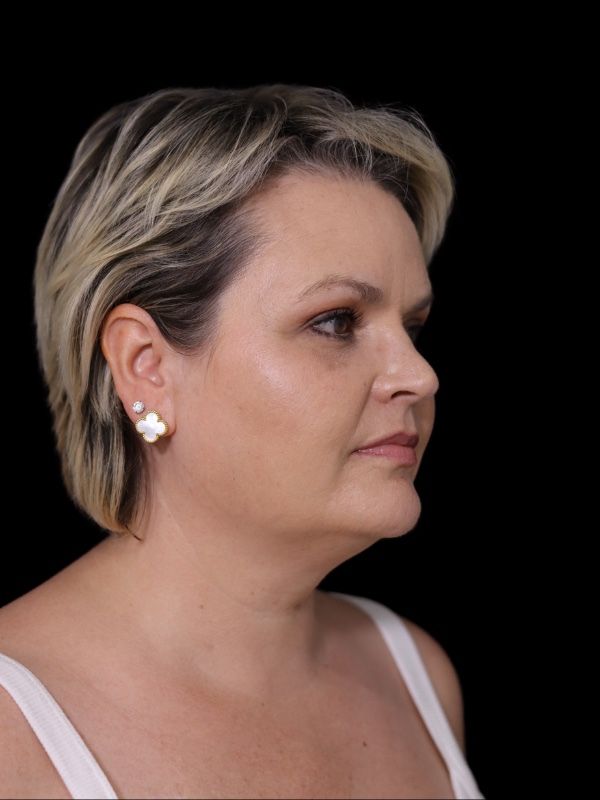 Deep Plane Facelift Gallery Before & After