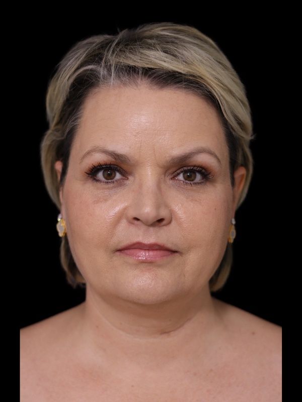 Deep Plane Facelift Gallery Before & After