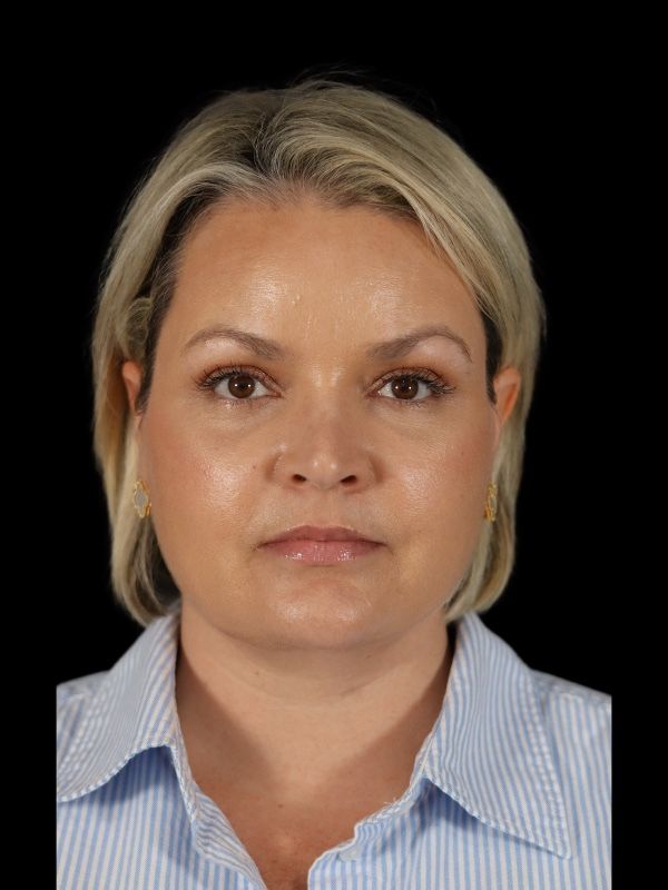 Deep Plane Facelift Gallery Before & After