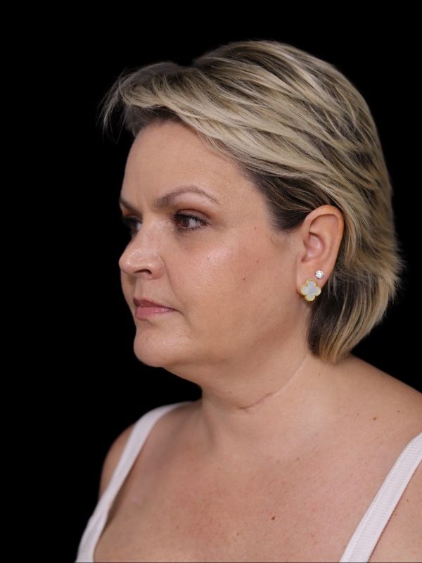 Deep Plane Facelift Gallery Before & After