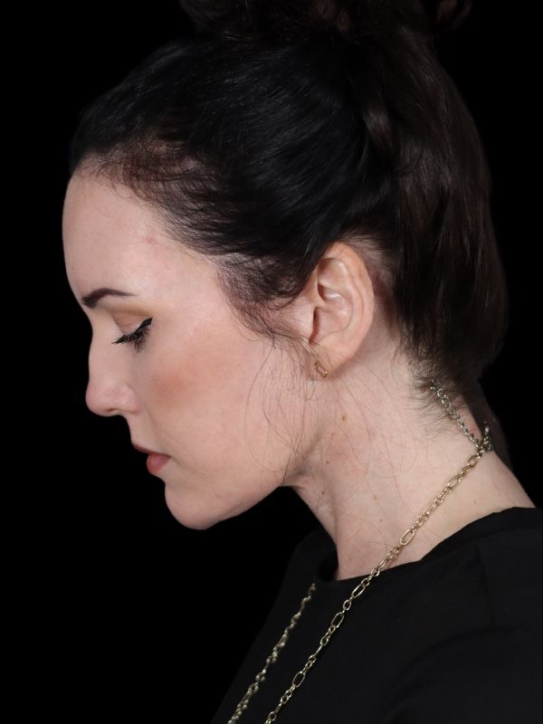 Deep Plane Facelift Gallery Before & After