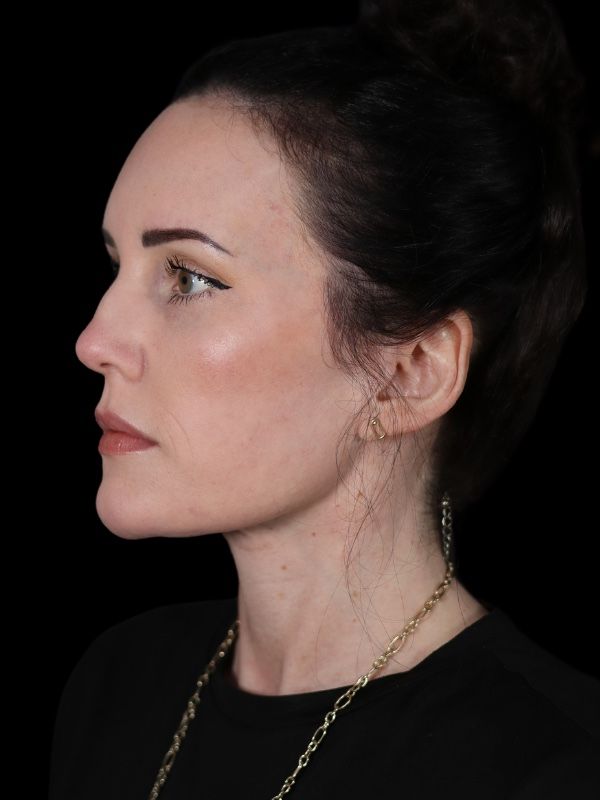 Deep Plane Facelift Gallery Before & After